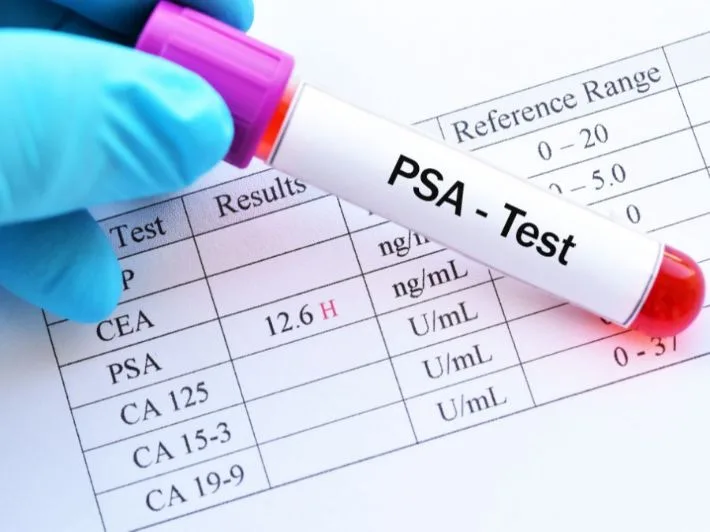 تعليمات PSA (تحليل البروستاتا)