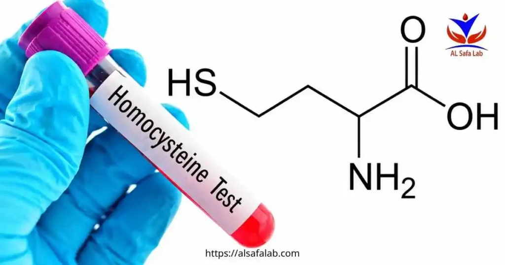 Homocysteine Test