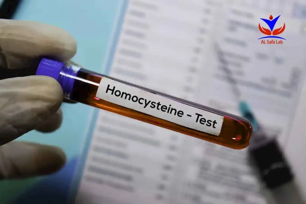 تحليل Homocysteine