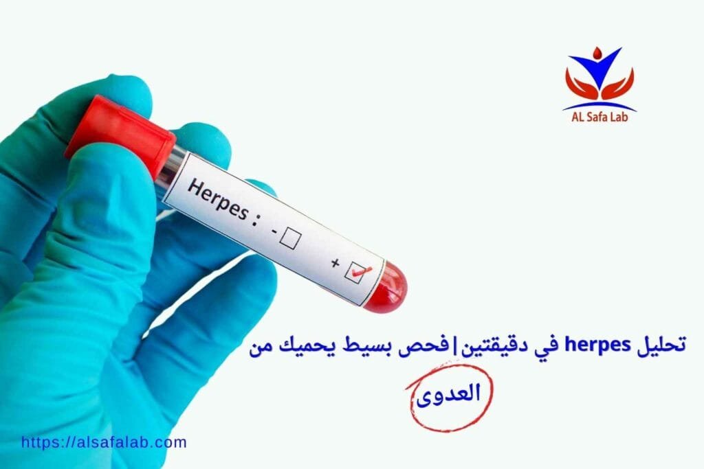 تحليل herpes