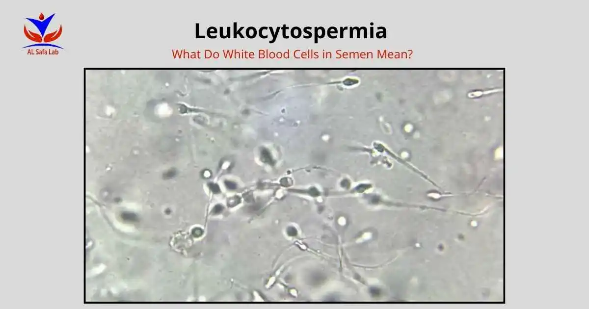 Leukocytospermia