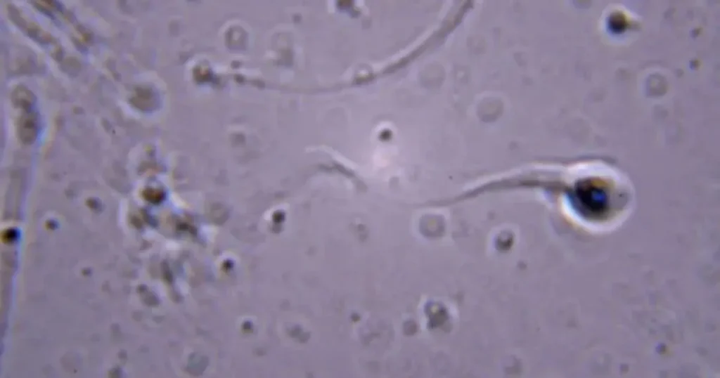 Leukocytospermia